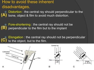 How to avoid these inherent
disadvantages.
 Distortion : the central ray should perpendicular to the
bone, object & film to avoid much distortion.
 Fore-shortening : the central ray should not be
perpendicular to the film but to the implant
 Elongation : the central ray should not be perpendicular
to the object, but to the film.
 