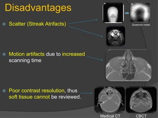 Disadvantages
 Scatter (Streak Atrifacts)
 Motion artifacts due to increased
scanning time
 Poor contrast resolution, thus
soft tissue cannot be reviewed.
Medical CT CBCT
Quantum noise
 