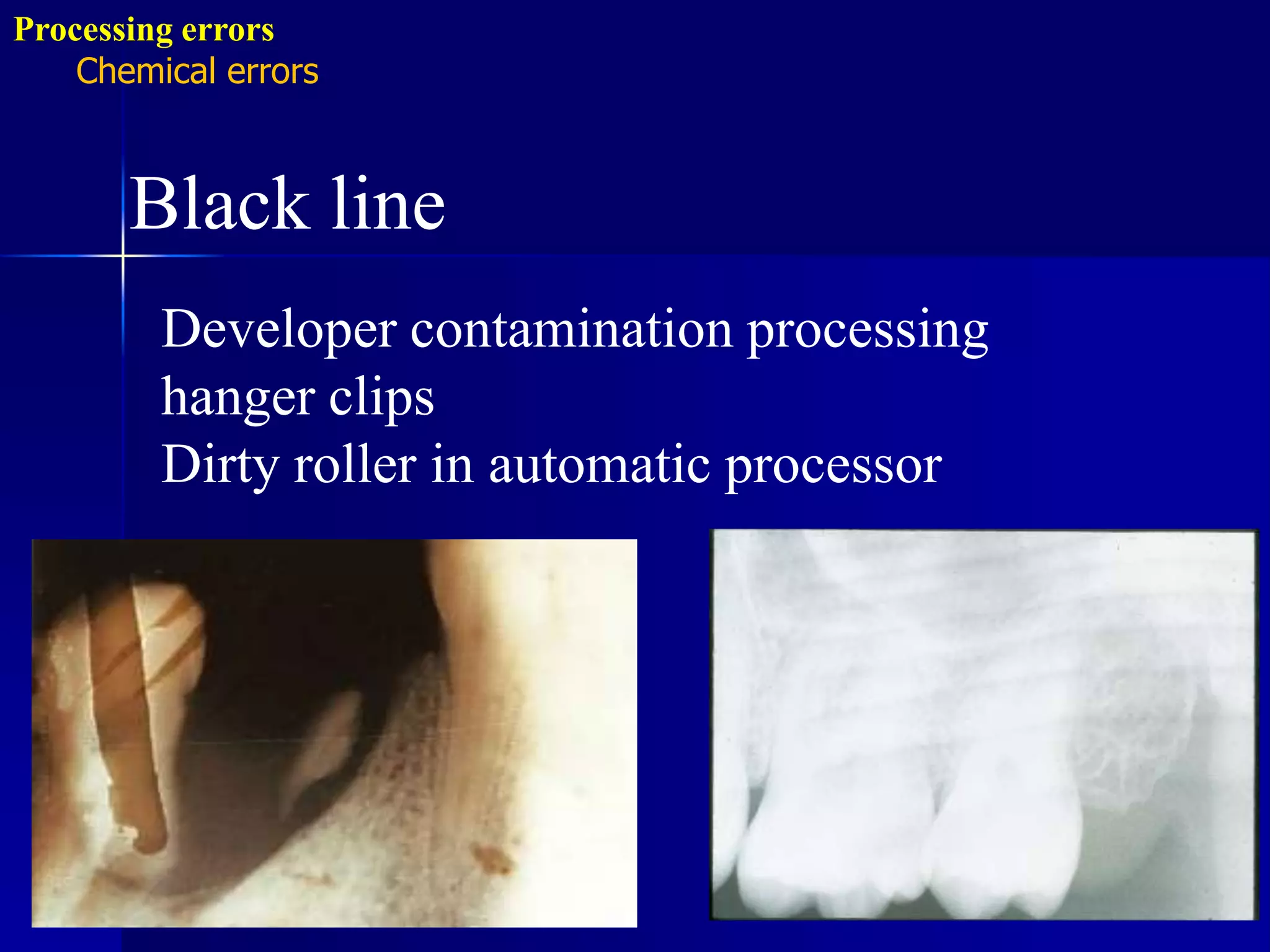 Radiographic errors and artifacts | PPTX