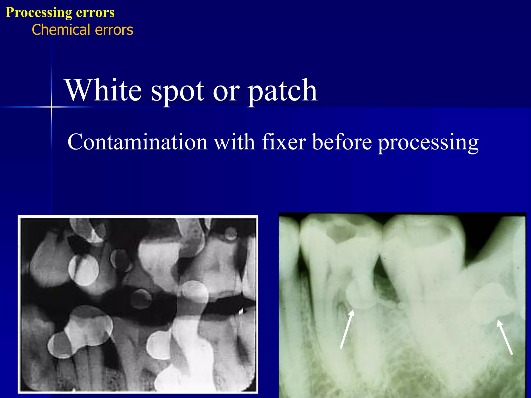 Radiographic errors and artifacts | PPTX
