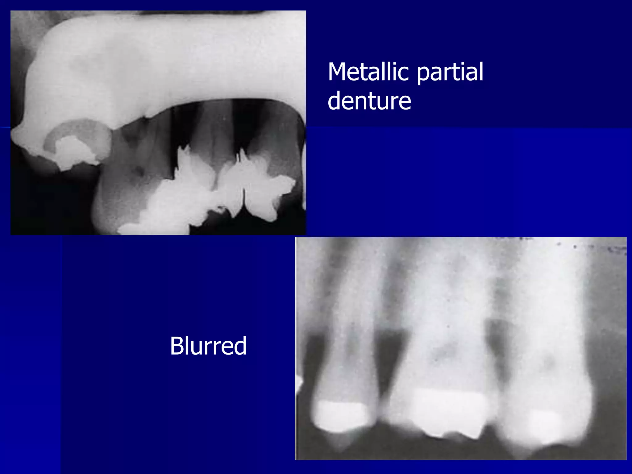 Radiographic errors and artifacts | PPTX