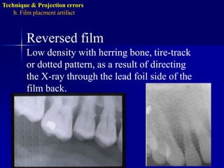 Technique & Projection errorsa. Patient preparation error:Pressure markPressure from the incisal edge & cusps of the teeth (mostly in the pediatric occlusal radiograph).May appear black or white.Correction: ask the patient to bite gently.
