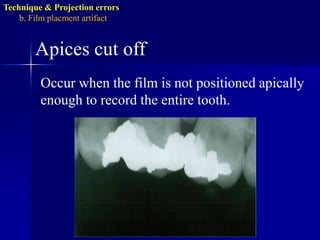 Technique & Projection errorsb. Film placmentartifactReversed filmLow density with herring bone, tire-track or dotted pattern, as a result of directing the X-ray through the lead foil side of the film back. 