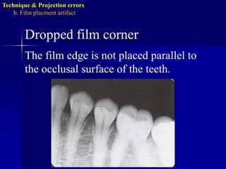Technique & Projection errorsb. Film placmentartifactApices cut offOccur when the film is not positioned apically enough to record the entire tooth.