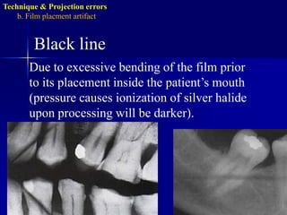 Technique & Projection errorsb. Film placmentartifactDropped film cornerThe film edge is not placed parallel to the occlusal surface of the teeth.