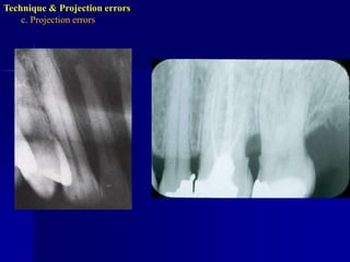 Technique & Projection errorsb. Film placmentartifactnormaldistortionDistortionDue to bending of the film to eliminate the patient’s  discomfort specially in lower premolar area and upper central incisors.