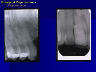 Technique & Projection errorsc. Projection errors