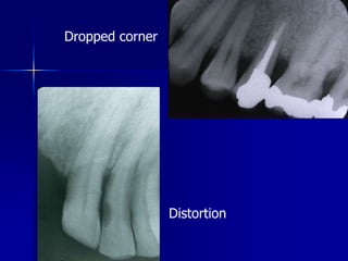 Processing errorsChemical errorsBlack spot or patchDeveloper contamination before immersion into the developer solution.