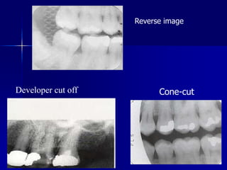Radiographic Errors And Artifacts