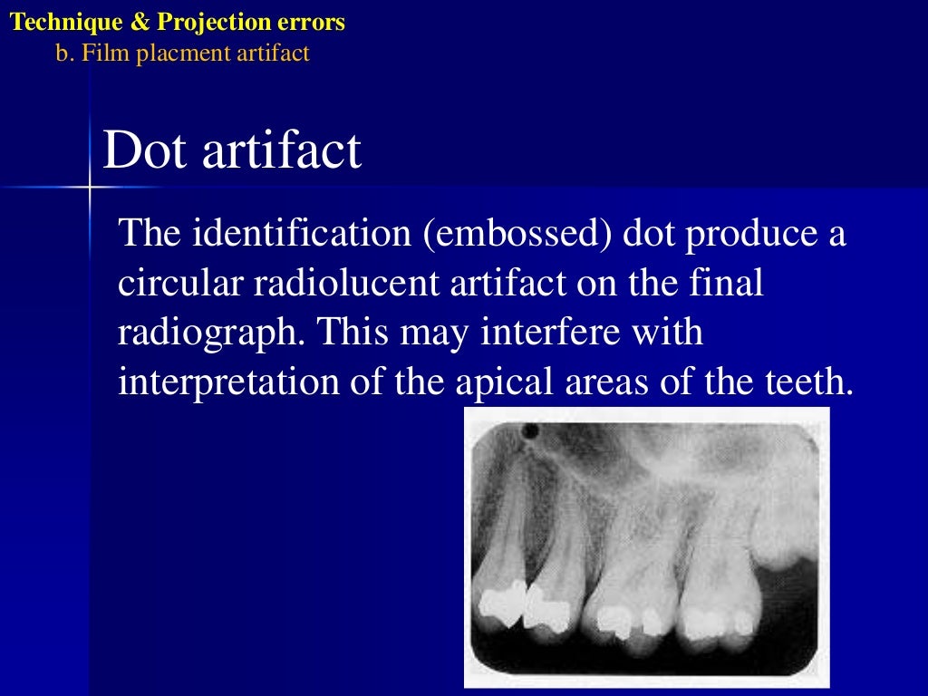 Radiographic errors and artifacts