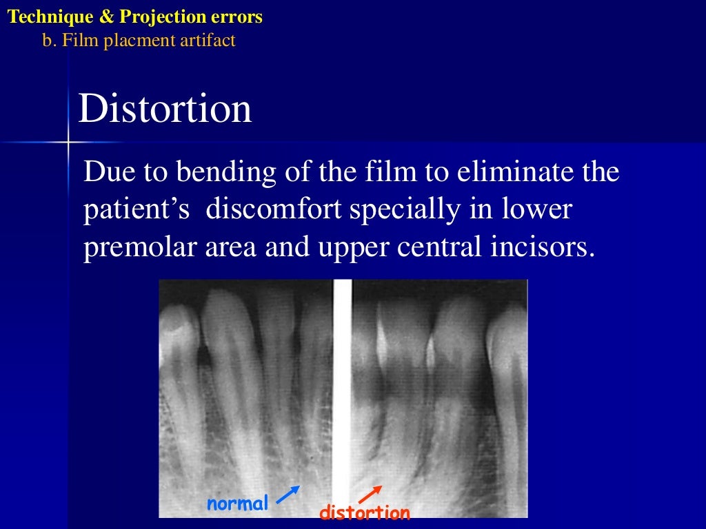 Radiographic errors and artifacts