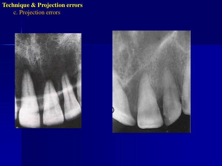 Radiographic errors and artifacts
