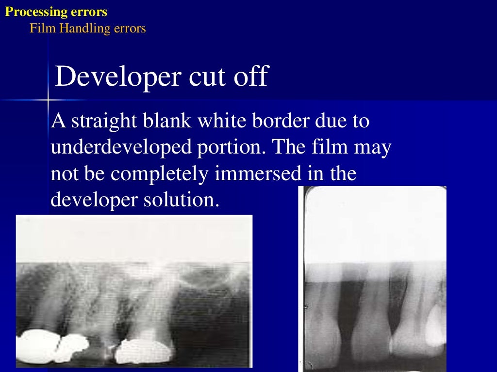 Radiographic errors and artifacts
