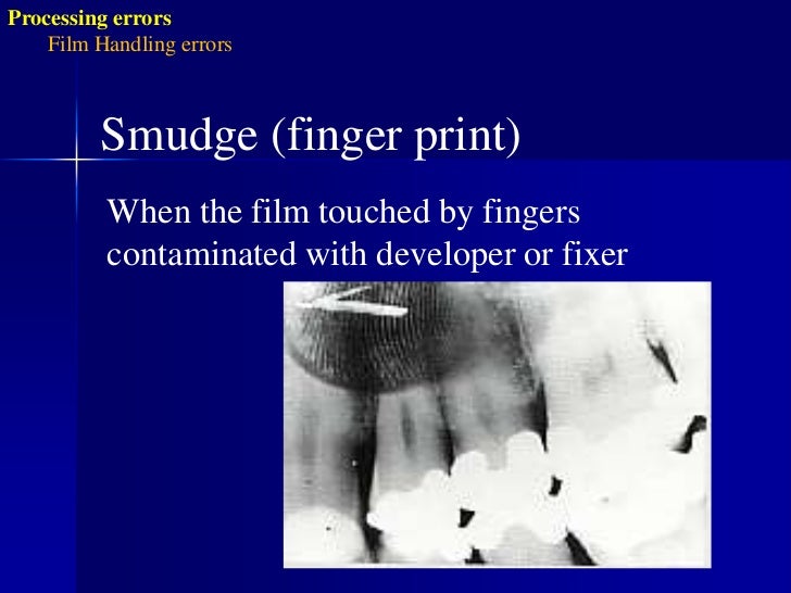 Radiographic errors and artifacts