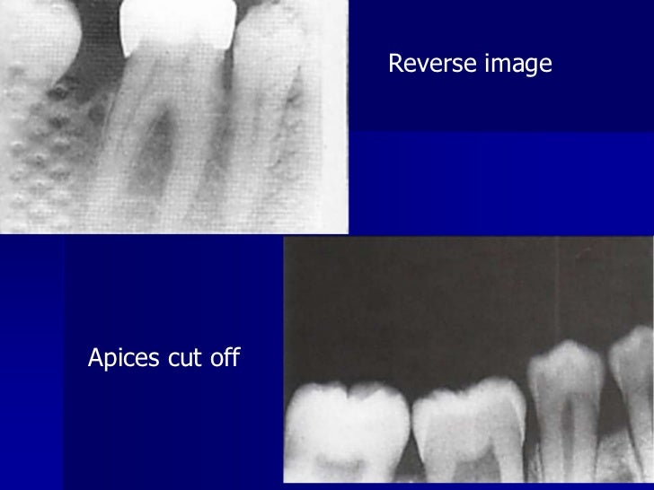 Radiographic errors and artifacts