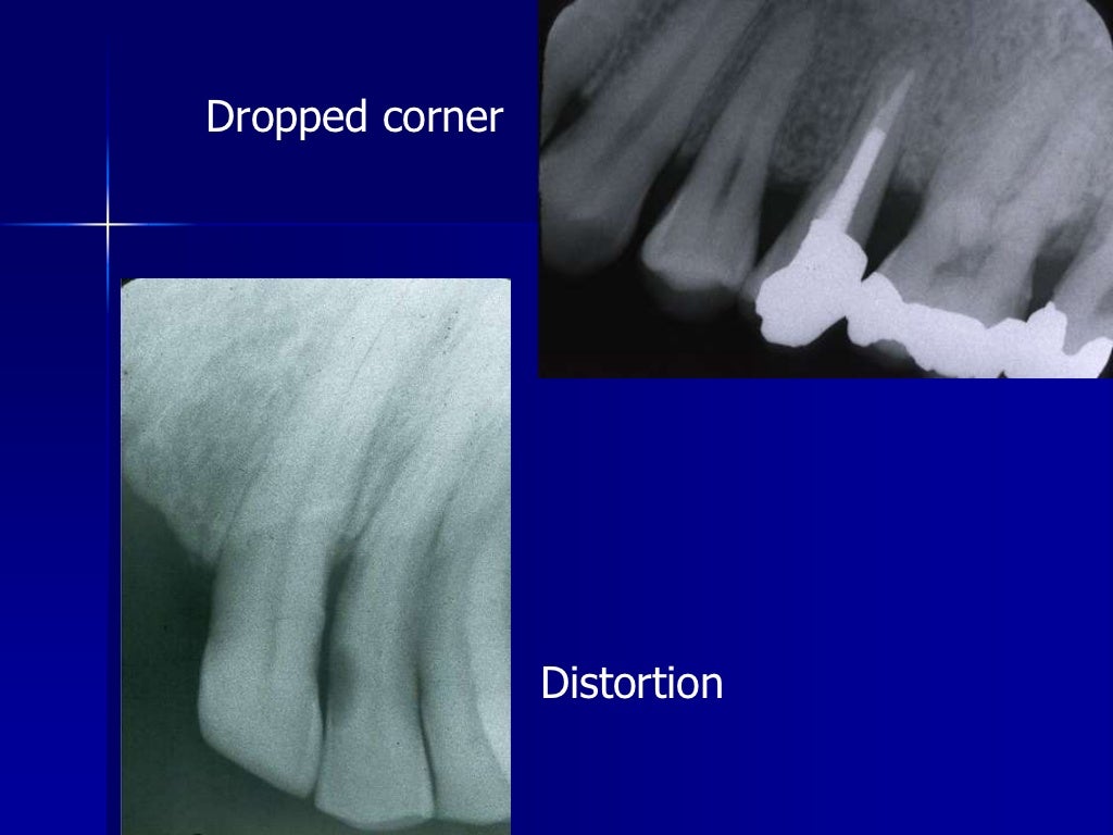 Radiographic errors and artifacts