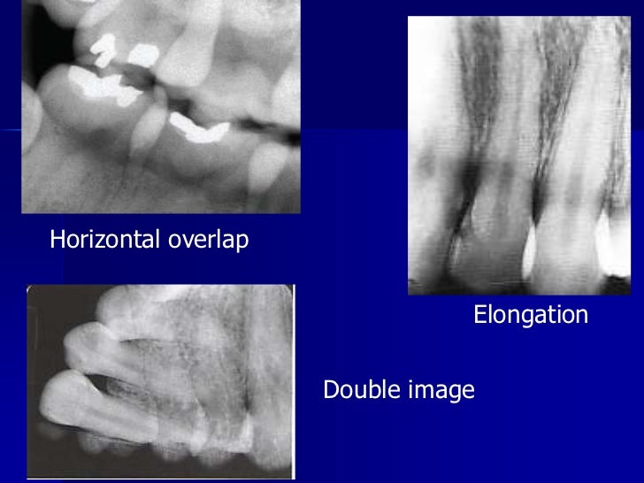 Radiographic errors and artifacts