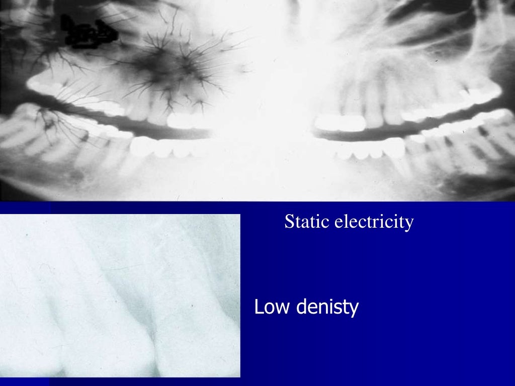 Radiographic errors and artifacts