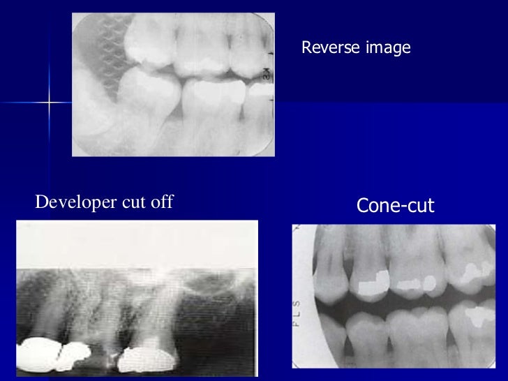Radiographic errors and artifacts