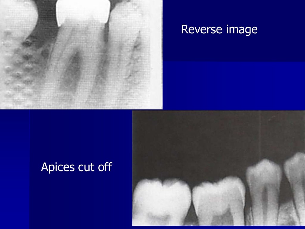 Radiographic errors and artifacts
