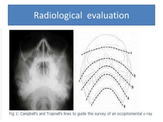 Radiographic evaluation of midface fracture | PPTX