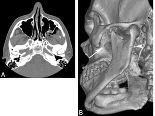 Radiographic evaluation of midface fracture | PPTX