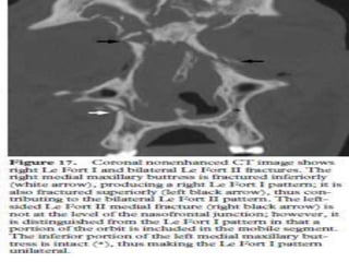 Radiographic evaluation of midface fracture | PPTX