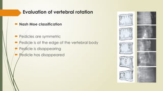 Radiographic evaluation of scoliosis.pptx