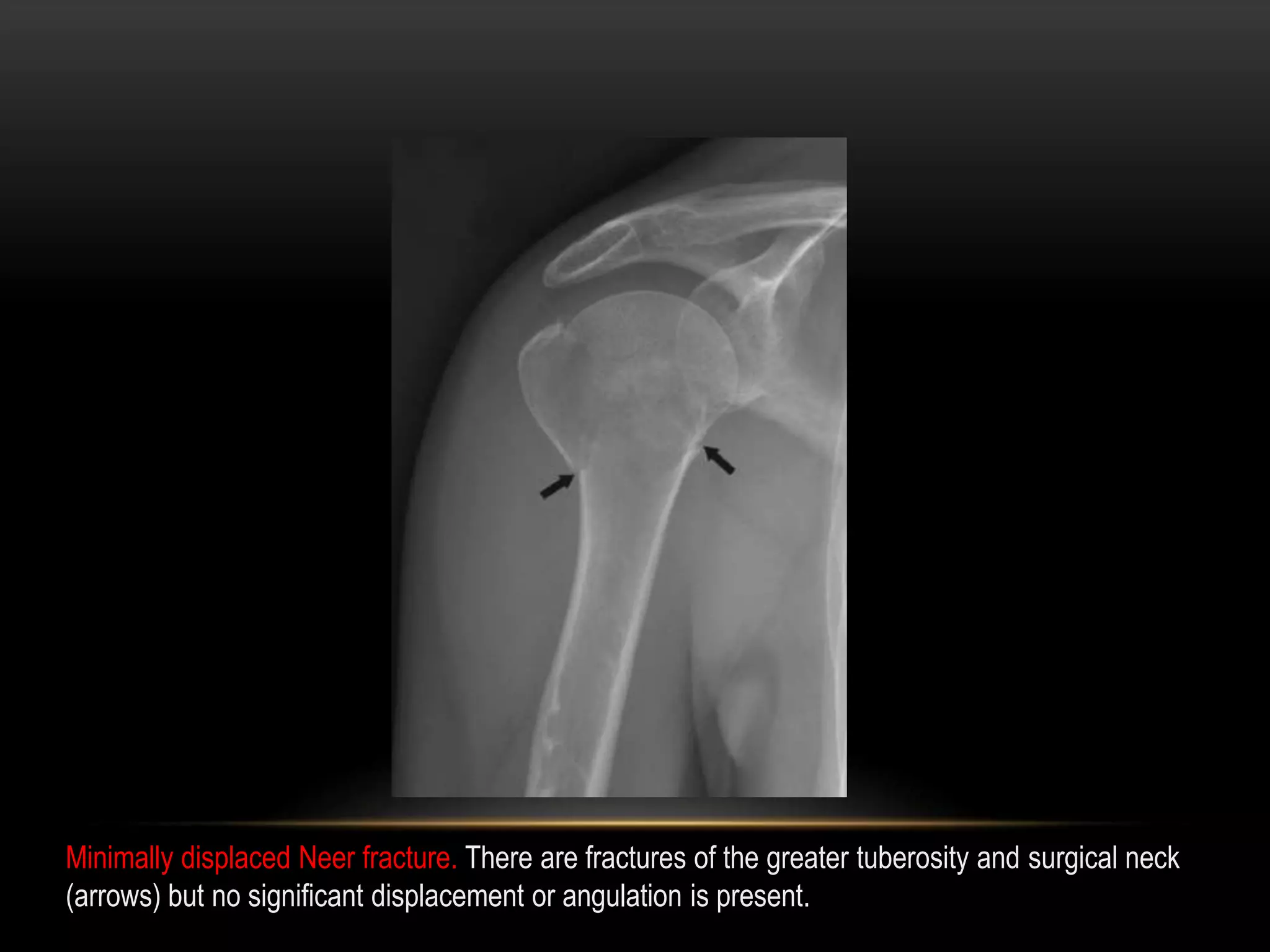 Radiographic evaluation of shoulder | PPTX