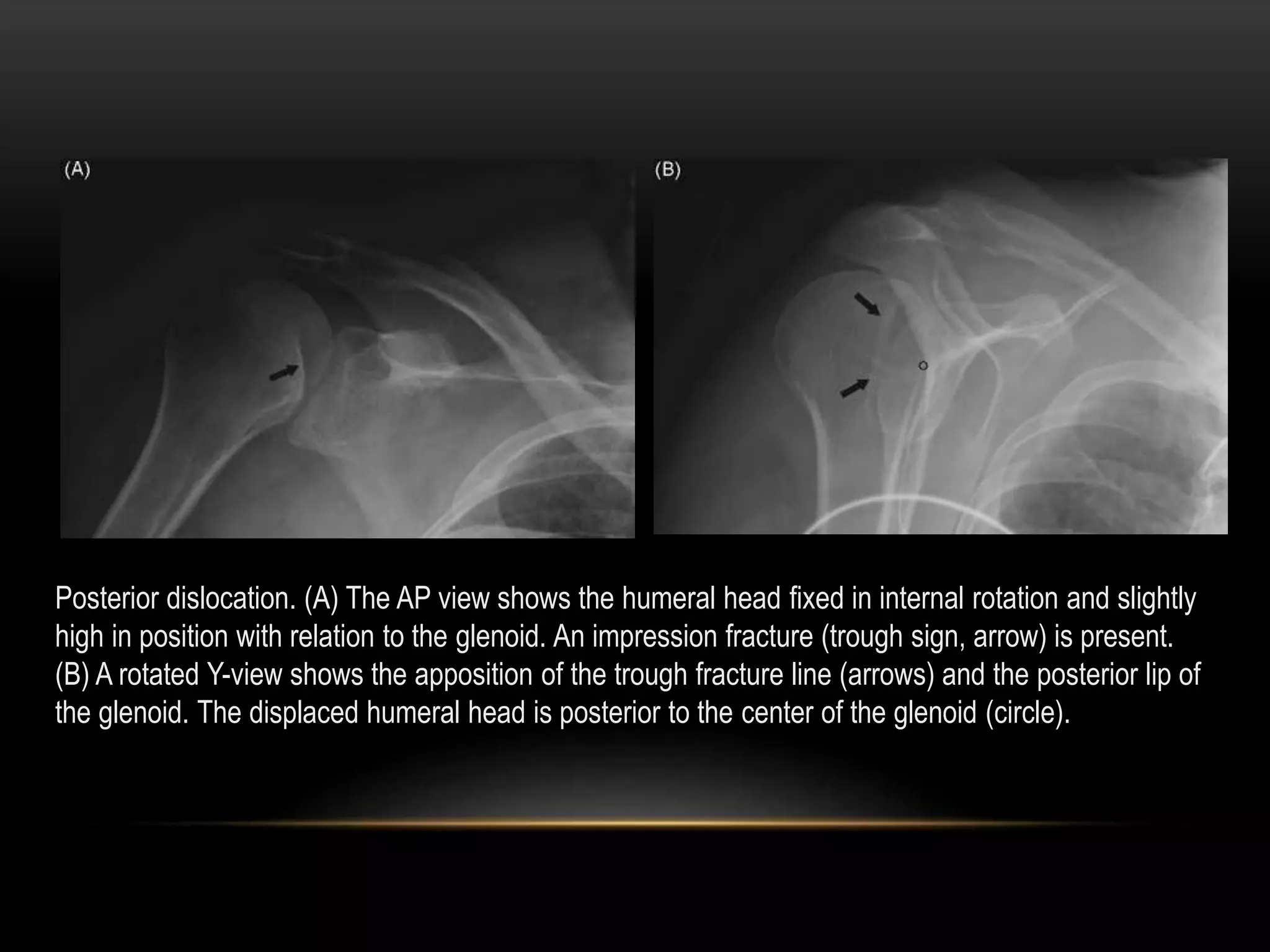 Radiographic evaluation of shoulder | PPTX