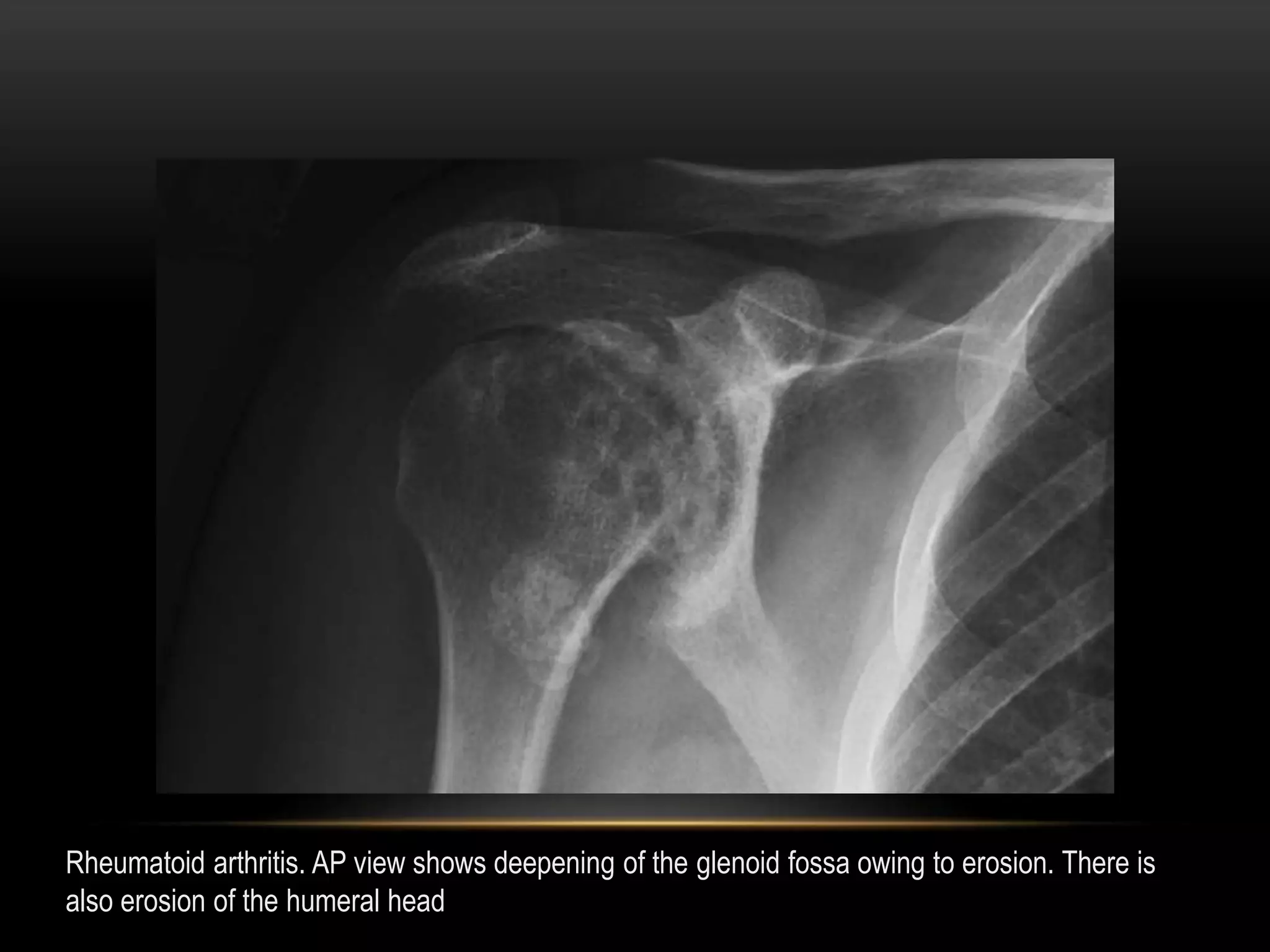 Radiographic evaluation of shoulder | PPTX