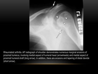 Radiographic evaluation of shoulder | PPTX