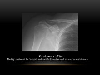 Radiographic evaluation of shoulder | PPTX