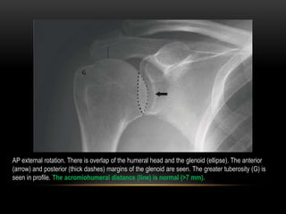 AP external rotation. There is overlap of the humeral head and the glenoid (ellipse). The anterior
(arrow) and posterior (...