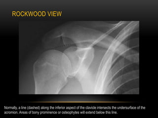 ROCKWOOD VIEW
Normally, a line (dashed) along the inferior aspect of the clavicle intersects the undersurface of the
acrom...