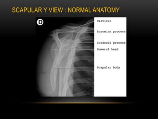 Radiographic evaluation of shoulder