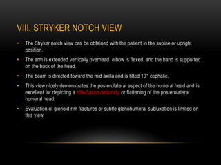 VIII. STRYKER NOTCH VIEW
• The Stryker notch view can be obtained with the patient in the supine or upright
position.
• Th...