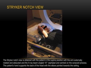 STRYKER NOTCH VIEW
The Stryker notch view is obtained with the patient in the supine position with the arm externally
rota...