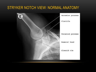 Radiographic evaluation of shoulder