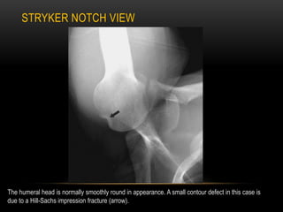 STRYKER NOTCH VIEW
The humeral head is normally smoothly round in appearance. A small contour defect in this case is
due t...
