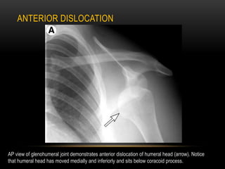 AP view of glenohumeral joint demonstrates anterior dislocation of humeral head (arrow). Notice
that humeral head has move...