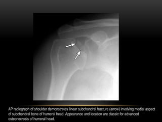 AP radiograph of shoulder demonstrates linear subchondral fracture (arrow) involving medial aspect
of subchondral bone of ...