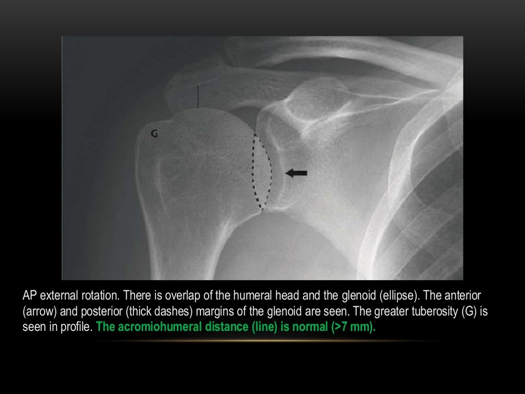Radiographic evaluation of shoulder