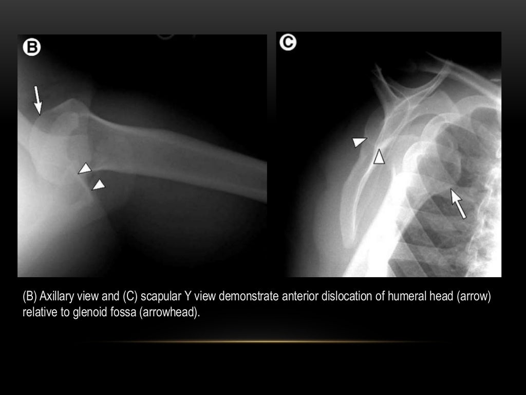 Shoulder Radiography Internal Rotation Radiographic Evaluation Of Patients With Anterior Shoulder Instability ...