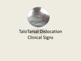 TaloTarsal DislocationClinical Signs 
