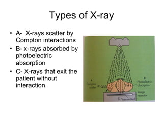 Types of X-ray A-  X-rays scatter by Compton interactions B- x-rays absorbed by photoelectric absorption C- X-rays that exit the patient without interaction. 