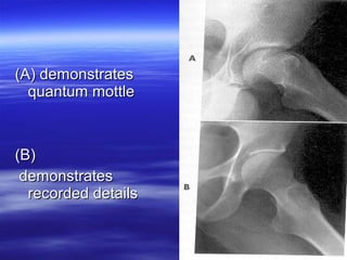 (A) demonstrates
quantum mottle

(B)
demonstrates
recorded details

 