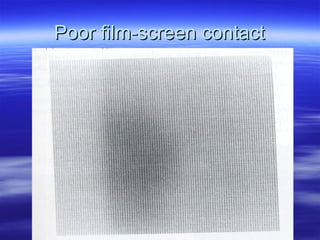 Poor film-screen contact

 