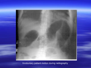 Involuntary patient motion during radiography

 