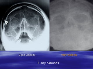 Good Visibility

Poor Visibility

X-ray Sinuses

 